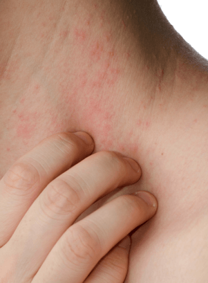 histamine allergy